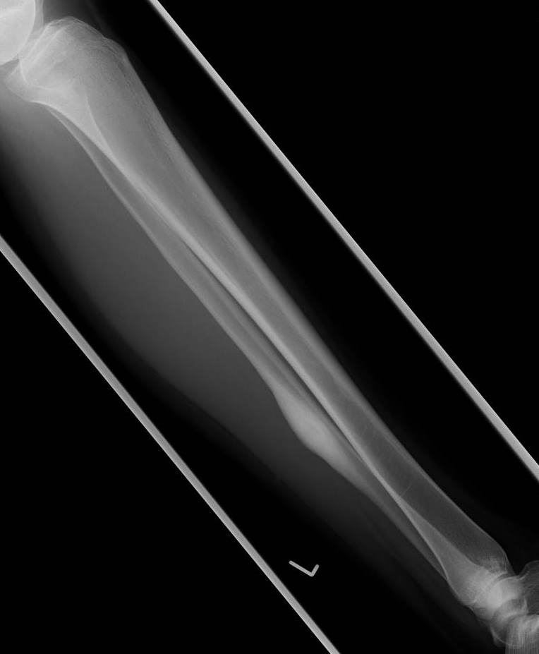 Bone Tumours And Benign Lytic Lesions